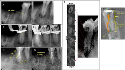 Unique root anatomy of mandibular second premolars: clinical strategies for effective disinfection and preservation of dentine structure in root canal treatment—a case report